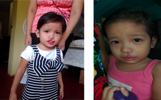 Cleft Lip and Palate CSR Program of AutoDeal